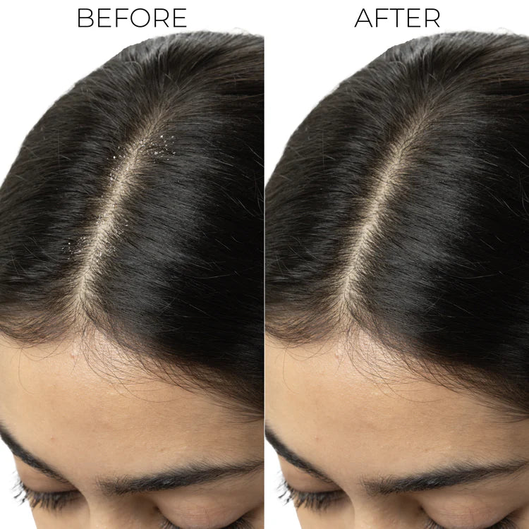 Brillare Dandruff Control Conditioner – Soothing Relief for Itchy, Flaky Scalp